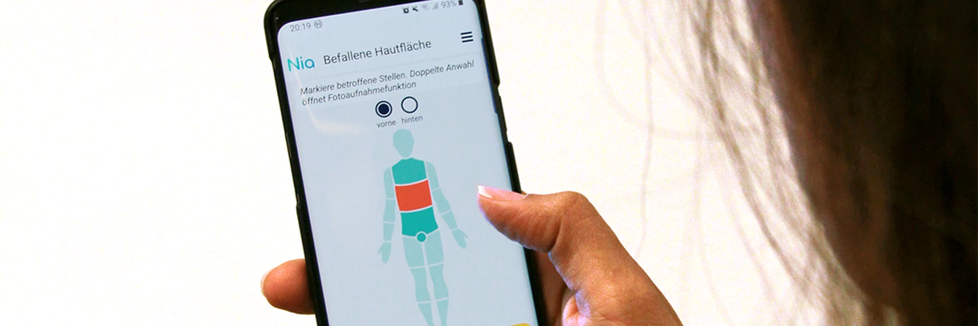 HanseMerkur bietet digi­tale Hilfe für Neuro­der­mitis-Betrof­fene